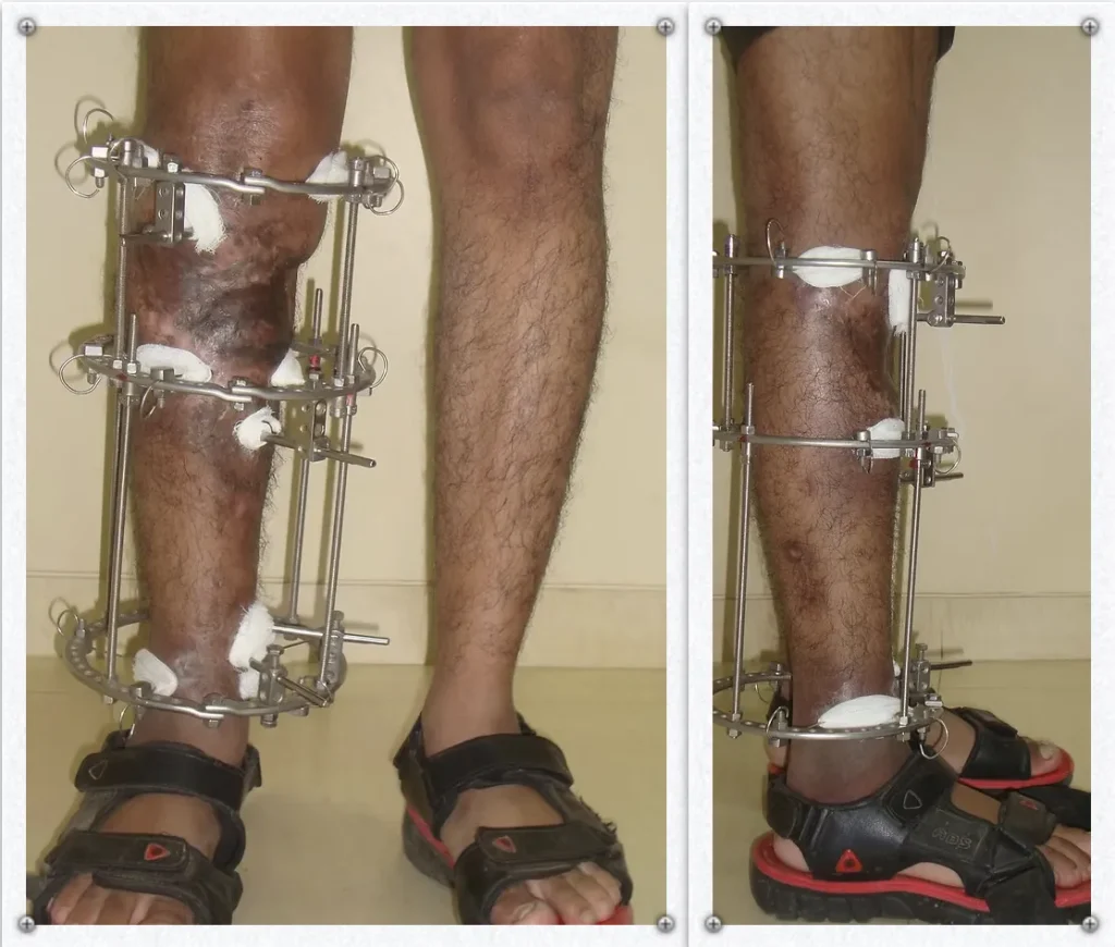 Front and side views of a leg with a linear external fixator applied below the knee