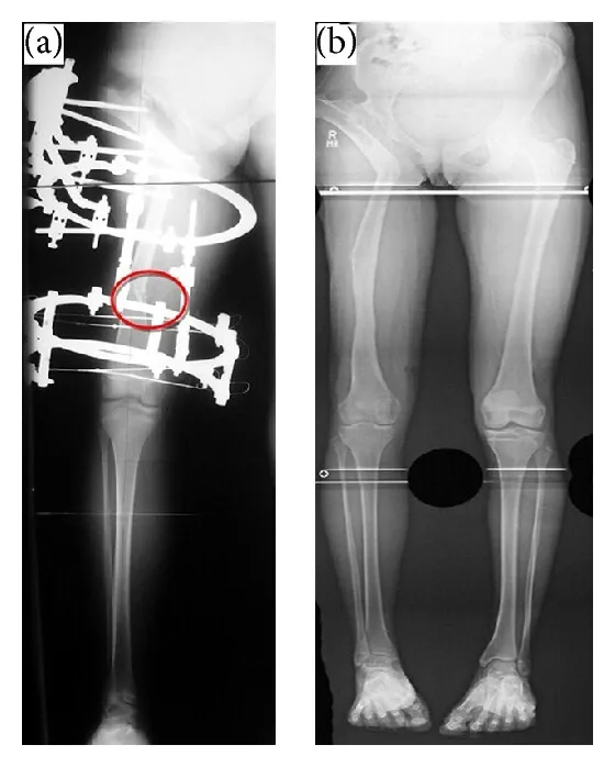 X-ray showing leg with external fixator before treatment and corrected, aligned legs after