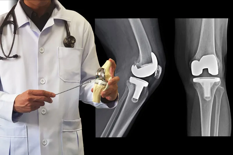 Doctor explaining knee replacement implant model alongside X-rays of implanted knee joint
