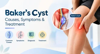 Baker's Cyst (Popliteal Cyst): Causes, Symptoms, and Treatment